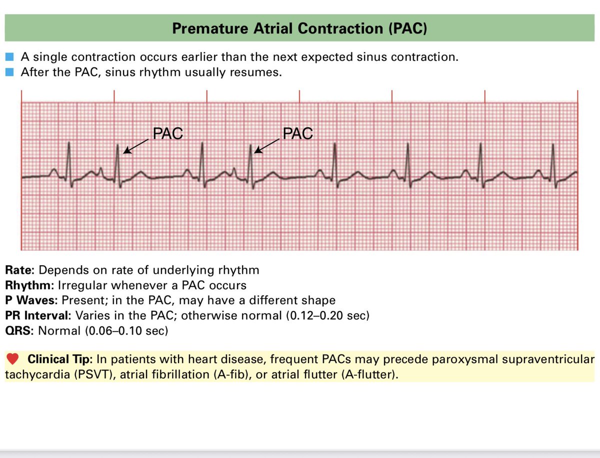 MRCEMExams's tweet photo. Cardiology and ECG important information!#emergencymedicine #exams #physicians #mrcem https://t.co/kpxXNWyLkf