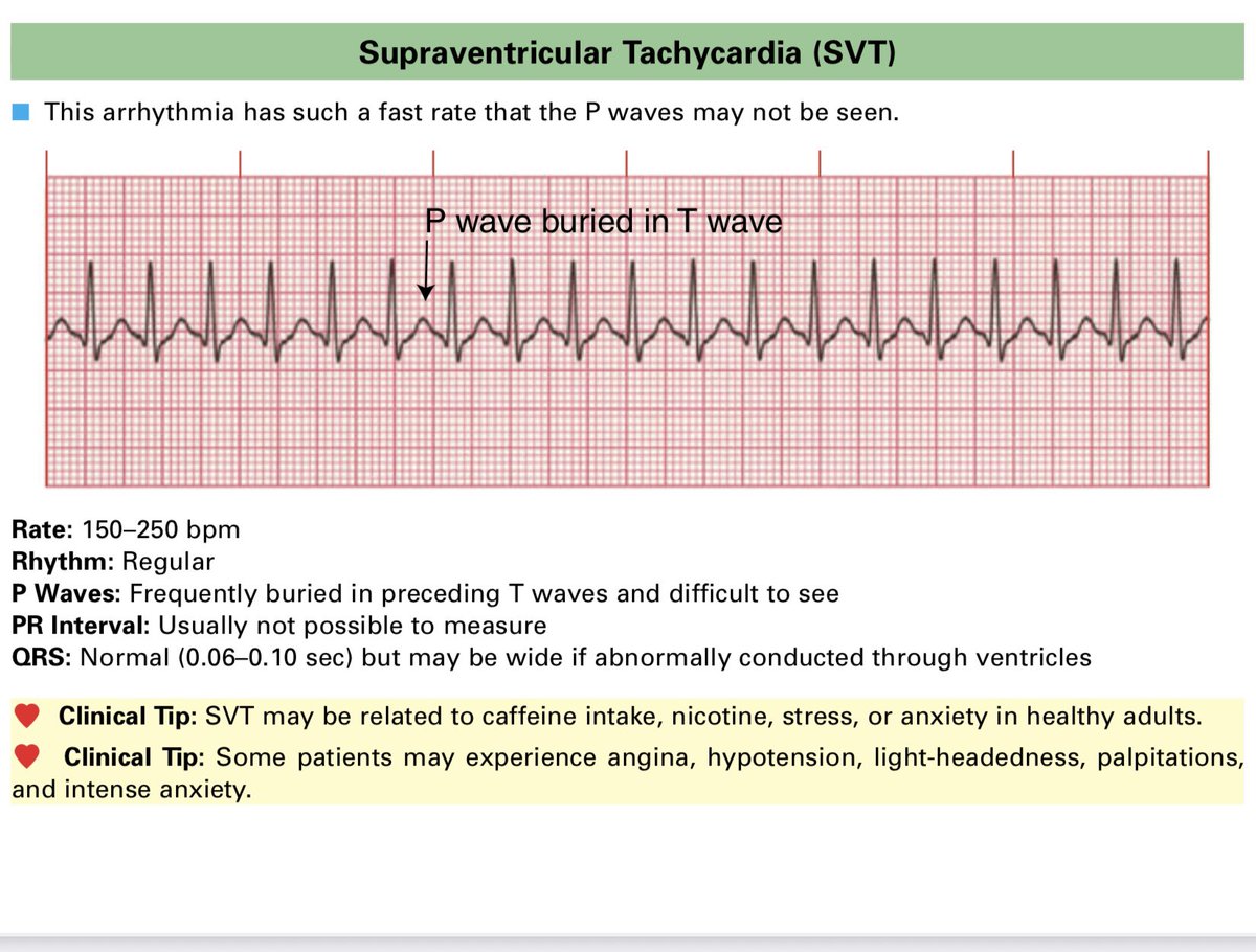 MRCEMExams's tweet photo. Cardiology and ECG important information!#emergencymedicine #exams #physicians #mrcem https://t.co/kpxXNWyLkf