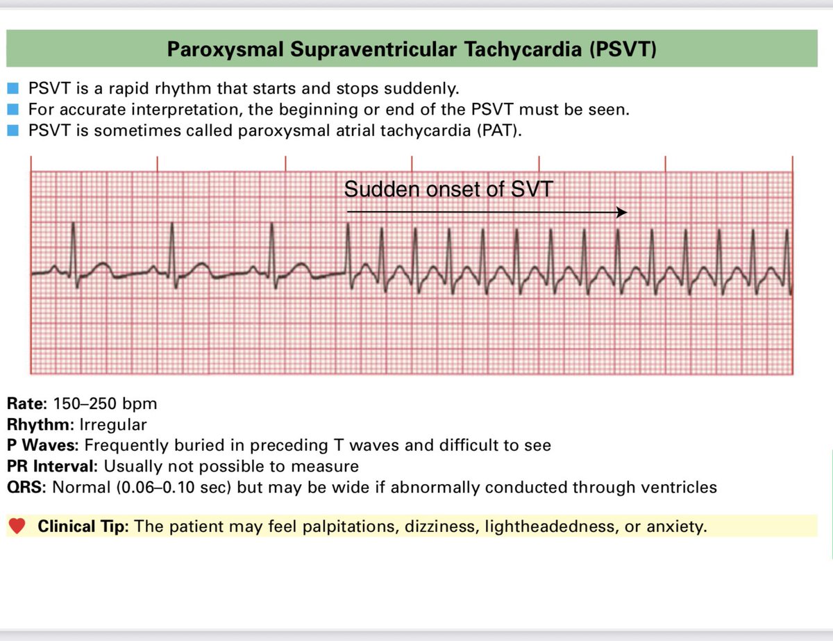 MRCEMExams's tweet photo. Cardiology and ECG important information!#emergencymedicine #exams #physicians #mrcem https://t.co/kpxXNWyLkf