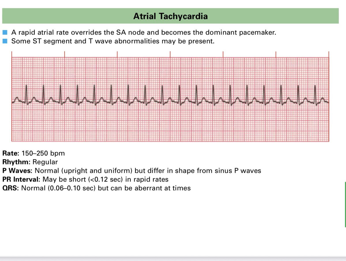 MRCEMExams's tweet photo. Cardiology and ECG important information!#emergencymedicine #exams #physicians #mrcem https://t.co/kpxXNWyLkf