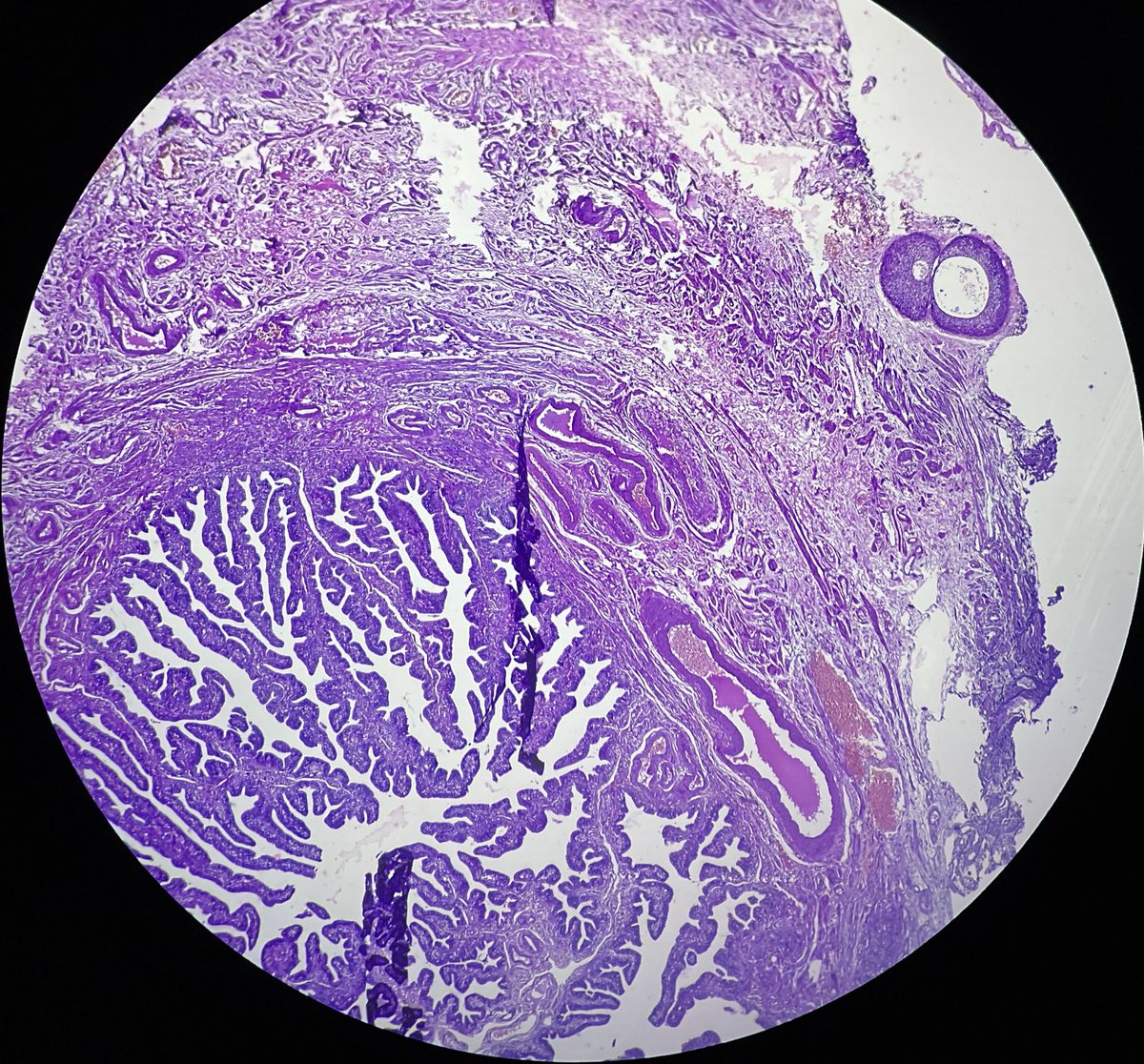 patho_mad's tweet image. WALTHARD CELL NESTS seen in the Serosa of fallopian tube. Resemble transitional epithelium showing central cystic change.