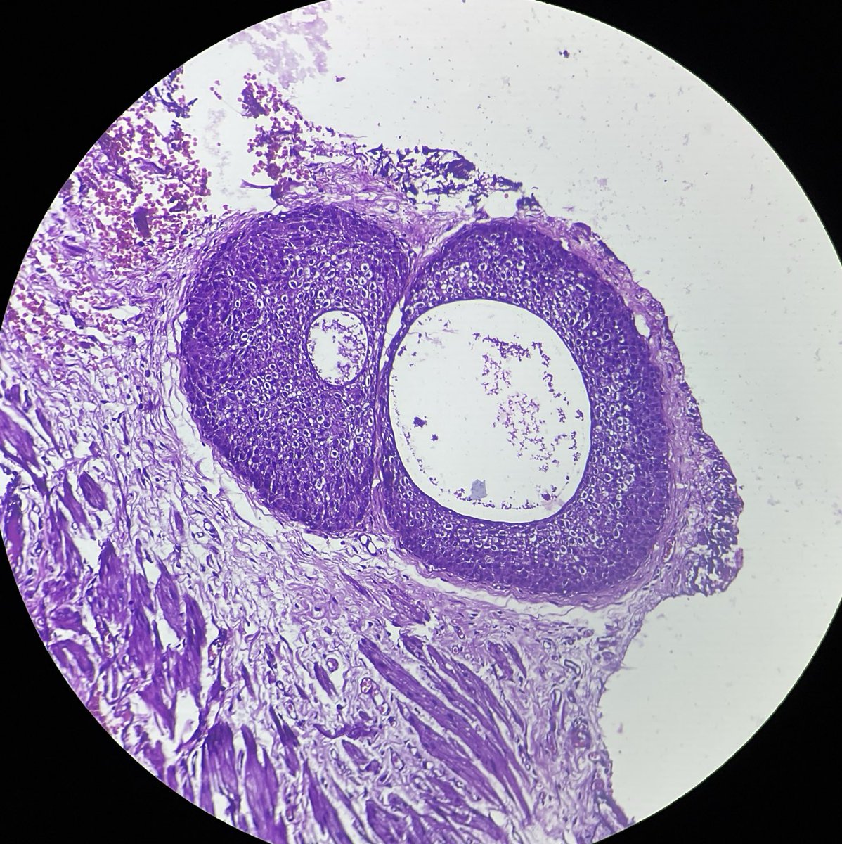 patho_mad's tweet image. WALTHARD CELL NESTS seen in the Serosa of fallopian tube. Resemble transitional epithelium showing central cystic change.