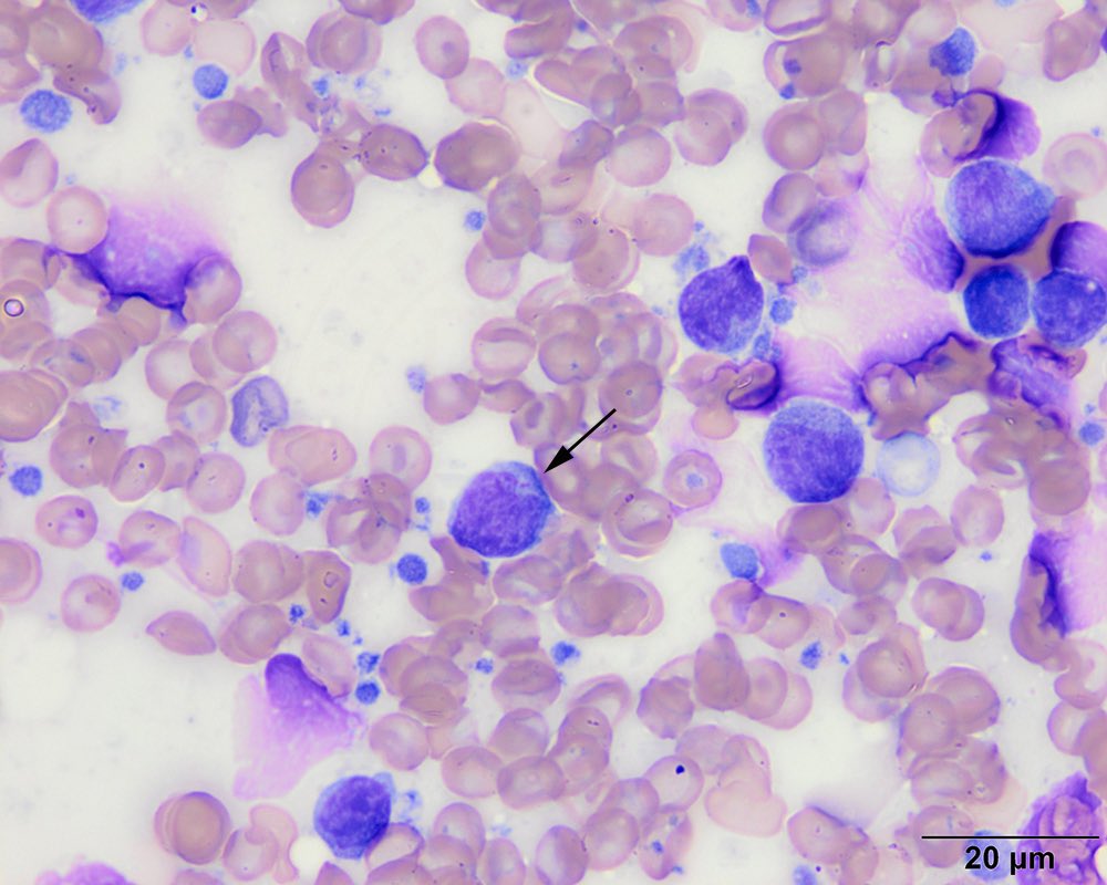 Aspirate of a mediastinal mass in a 4 year old dog: Large lymphocytes with a focus of red granules in the cytoplasm (arrow, image 4) dominate with a few small lymphocytes (arrows, images 1-3). A lymphoma of granular lymphocytes is rare in this location.