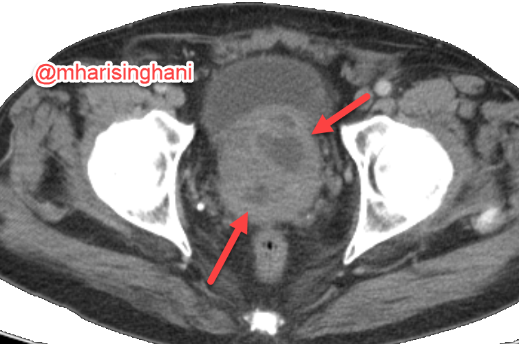 Prostatic abscesses on CT