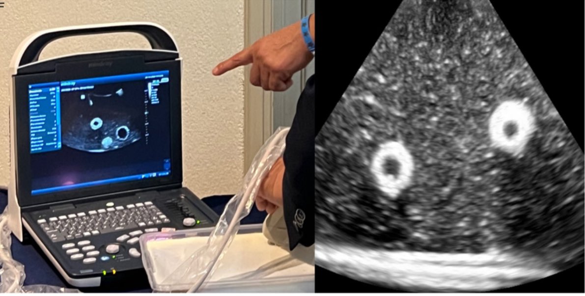 Enrique Pulido (@pulidouro) on Twitter photo Ultrasound guided PCNL:
How to make an inexpensive (Do it yourself) gelatin based model to practice Ultrasound guided puncture
We are very happy for our last publication:
pubmed.ncbi.nlm.nih.gov/40528490/
Free article: Open Access #US_PCNL
<a href="/CMUN_Urologia/">Colegio Mexicano de Urologia Nacional</a>
<a href="/Urologia_UMAET1/">Urologia UMAE T1</a> Ultrasound guided PCNL:
How to make an inexpensive (Do it yourself) gelatin based model to practice Ultrasound guided puncture
We are very happy for our last publication:
pubmed.ncbi.nlm.nih.gov/40528490/
Free article: Open Access #US_PCNL
<a href="/CMUN_Urologia/">Colegio Mexicano de Urologia Nacional</a>
<a href="/Urologia_UMAET1/">Urologia UMAE T1</a>