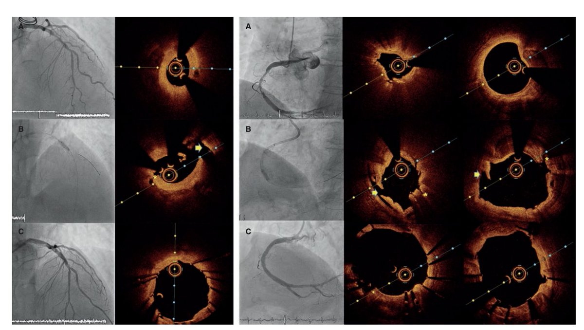 ACI-SEC: Hemodinamica (@shci_sec) on Twitter photo 📌 Resultados clínicos del scoring-🎈 Naviscore publicado en <a href="/RevEspCardiol/">REC Publications</a>
⚙️Registro Multicéntrico 🇪🇸 en 10 🏥
✅ 85 pts. 🪨 moderado 34%, severo 66%
✅ Éxito 94%
✅ Complicaciones 0%
<a href="/EstefaniaFdezP3/">Estefania Fernandez Peregrina</a> <a href="/jmmoreiras/">Javi Moreiras</a> <a href="/OjedaOjeda18/">Soledad Ojeda</a> <a href="/NievesGonzalo1/">Nieves Gonzalo</a> <a href="/AnderRegueiro/">Ander Regueiro</a> <a href="/iVascularGlobal/">iVascular</a> 📌 Resultados clínicos del scoring-🎈 Naviscore publicado en <a href="/RevEspCardiol/">REC Publications</a>
⚙️Registro Multicéntrico 🇪🇸 en 10 🏥
✅ 85 pts. 🪨 moderado 34%, severo 66%
✅ Éxito 94%
✅ Complicaciones 0%
<a href="/EstefaniaFdezP3/">Estefania Fernandez Peregrina</a> <a href="/jmmoreiras/">Javi Moreiras</a> <a href="/OjedaOjeda18/">Soledad Ojeda</a> <a href="/NievesGonzalo1/">Nieves Gonzalo</a> <a href="/AnderRegueiro/">Ander Regueiro</a> <a href="/iVascularGlobal/">iVascular</a>