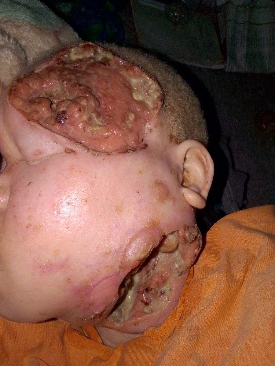🌙💛 We Don’t Have Sunscreen, Screening Services but with melanin,You Have a Choice 💛🌙
______________________________________________

Every day, someone living with albinism wakes up to a harsh sun and no protection. Not even a basic bottle of sunscreen. On the countryside