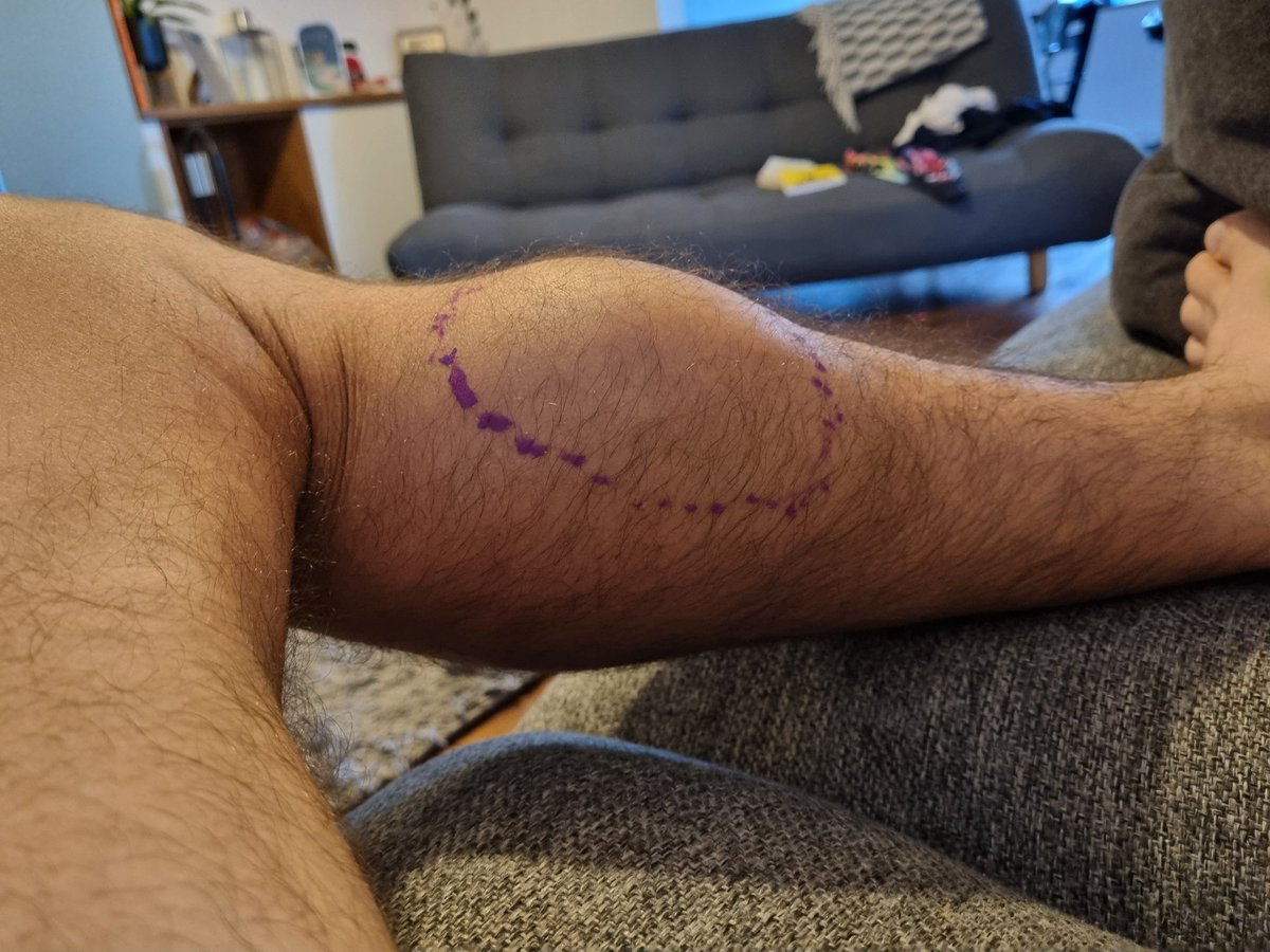 Acute swelling after calf whacked into fin on paddle board, when falling off.

Initially egg sized swelling, now tennis ball sized. 

3 hrs since injury. 

A haematoma that will spontaneously resolve, now im elevating....right?
🤔🤞🤦