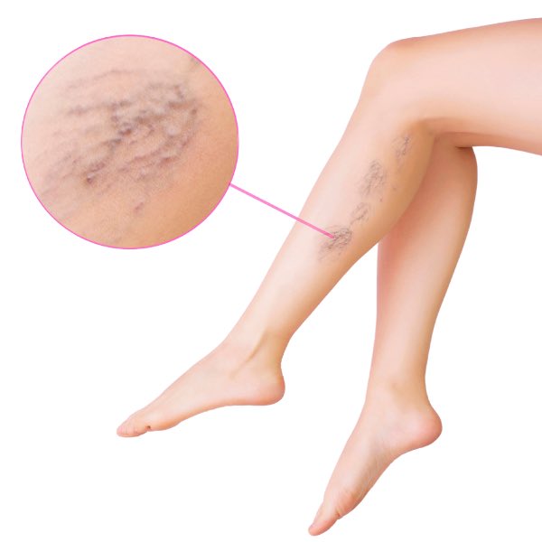 هل تعاني من ألم أو ثقل في الساقين؟ أو مظهر مزعج للأوردة البارزة؟

نقدم علاج الدوالي بأحدث التقنيات:
✅ بدون جراحة
✅ إجراء آمن وسريع
✅ تحسن تجميلي وصحي

تواصل/ي معي و احجز استشارتك الآن.
#الدوالي #علاج_الدوالي #صحة_الأوعية_الدموية #السعودية