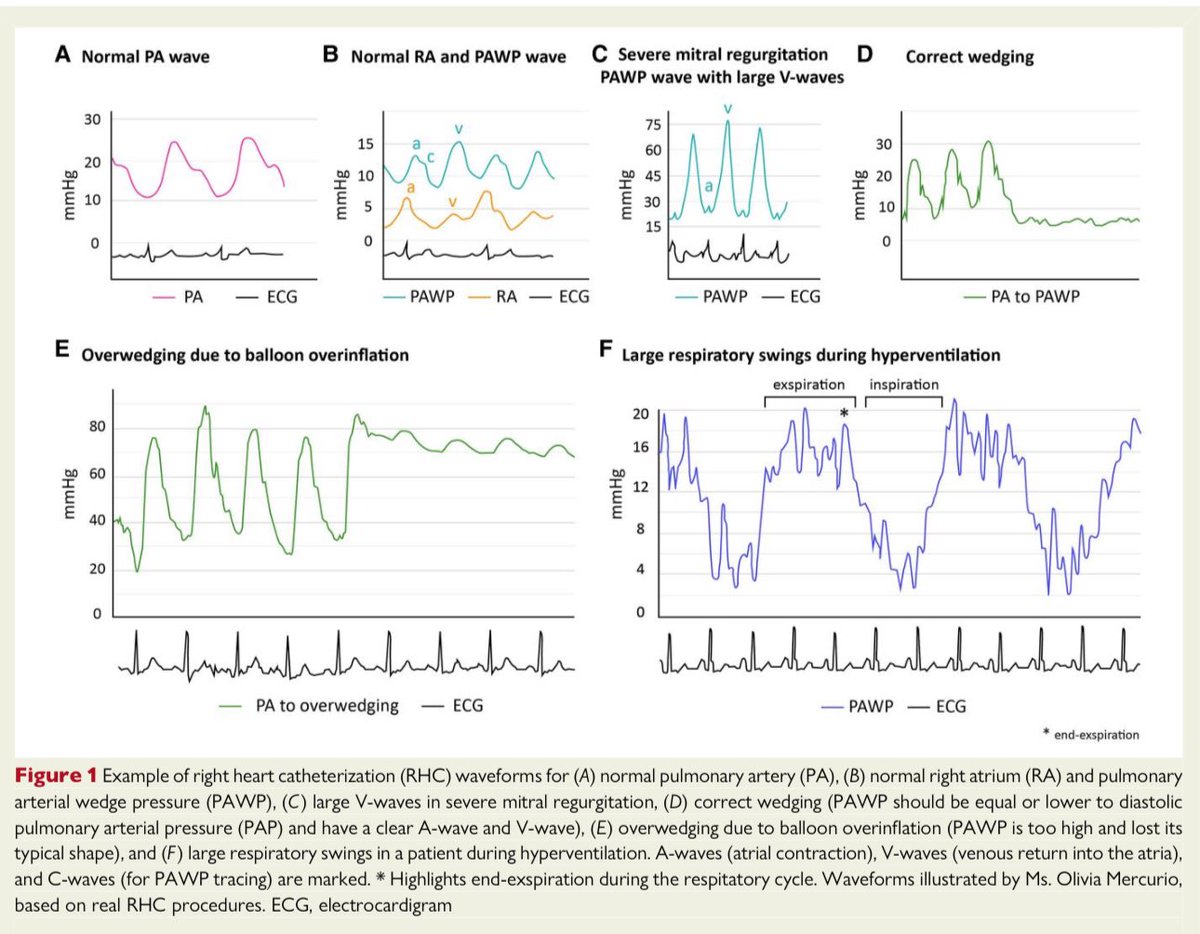 HanCardiomd's tweet photo. Different types of right heart catheterization (RHC) waveforms and central role of #PAWP in chronic heart failure 

#CardioEd #HeartFailure https://t.co/CvqC237og7