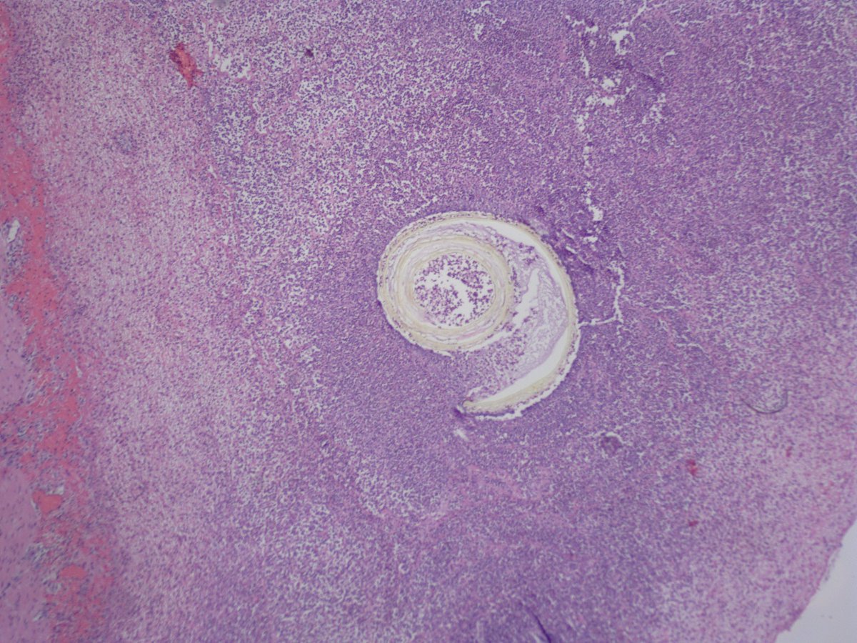 Teclis82's tweet image. #GIPath #IDPath @BrownPathology 

A 60 year old man presents with perforated diverticulitis - with a curious finding in the serosal inflammation:

Poll in reply.