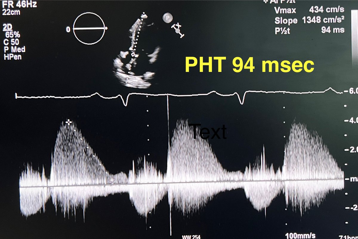 CASivaram1's tweet photo. Closing out
🙏 for all comments
✅ Diagnosis: Acute AR, premature MV closure & diastolic MR. Others: fine diastolic fluttering of AML, systolic MR
✅ See⬇️ for more images. 1st clip shows AV veg
✅ 2nd image: MR on color- easy to confuse timing of MR with color only & cursory reading (watch out!)
✅ 3rd image: #1 diastolic MR, #2 systolic MR, #3 Early diastolic mitral flow
✅ 4th image: CW AR very rapid decel, end diastolic Vel 0, AR stops before diastole is over
Question: is this diastolic MR due to acute AR or long PR?
@argulian 
@KemalogluOz 
@dr_benoy_n_shah 
@iamritu 
@DavidWienerMD