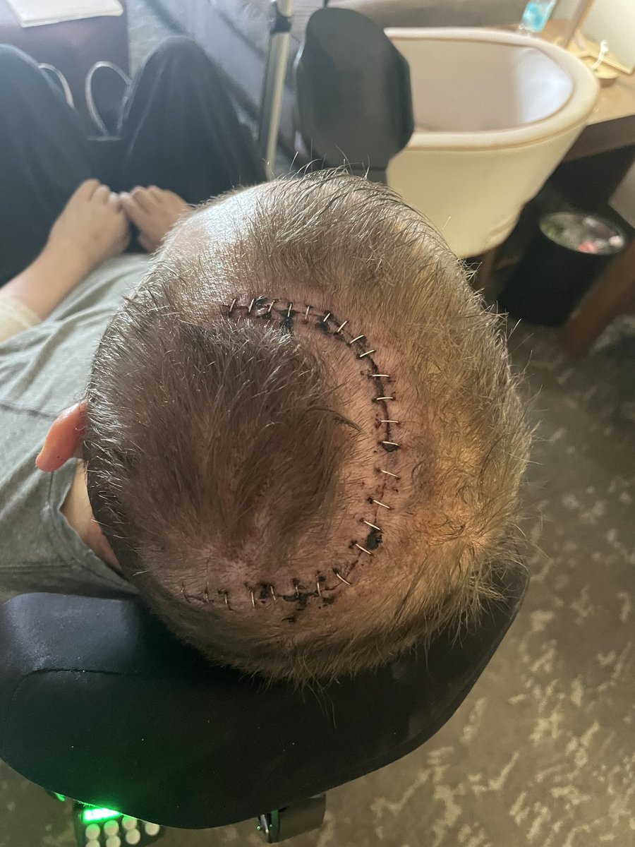 greiner_ro52817's tweet image. I finally had the Neuralink implant surgery!!