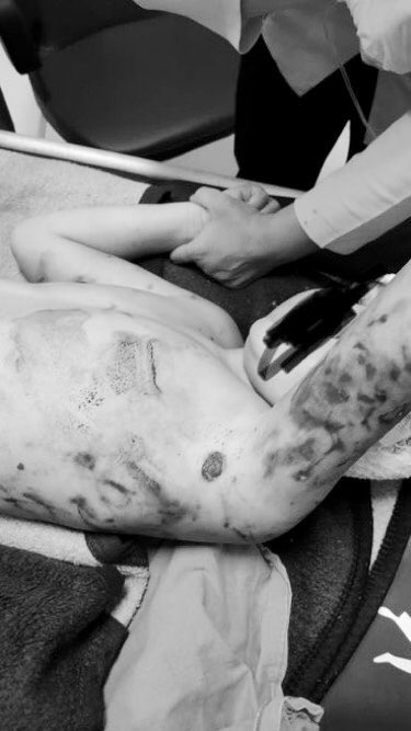 🔴| Erzincan'ın Üzümlü ilçesinde 10 Ocak 2022 tarihinde 9 yaşındaki Emir evladımız, başıboş köpek sürüsünün saldırısında adeta parçalanmıştı. Uğradığı saldırı sırasında kafa derisi yüzülen ve vücudunun her yerinden ısırılan küçük Emir, 3 ameliyat geçirdi ve kafasına 250 dikiş