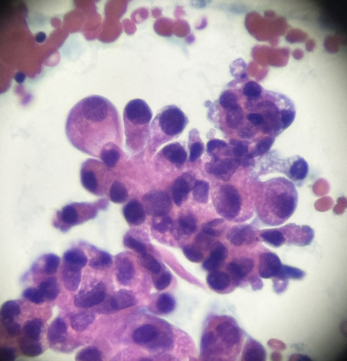 This hobnail subtype on Thyroid FNA reminds my this beautiful pink Dahlia from Monet’s garden at Giverny #pathart #cytopathology #thyroidfna #pathology #fnacytology #cytology #hobnail #thyroidcancer