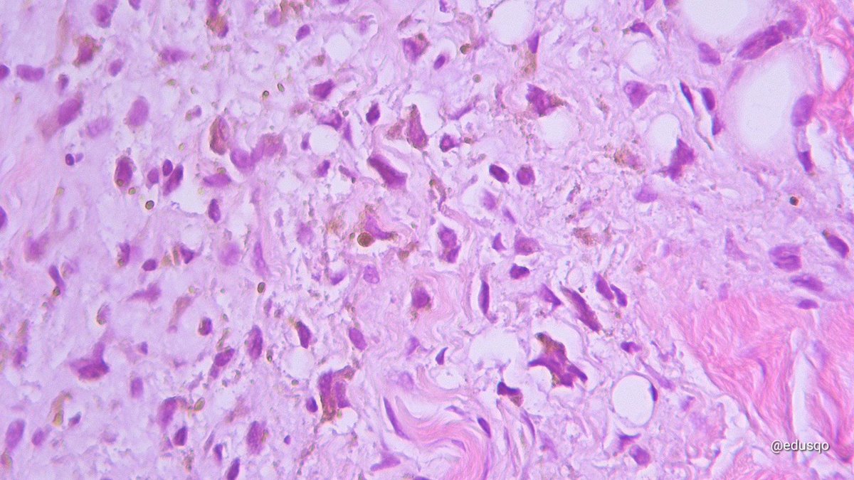 Spindle cell hemangioma:
▫️Cavernous blood vessels + spindle cell population, with hemosiderin deposits and cytoplasmic vacuoles.
▫️Thrombosis and papillary endothelial hiperplasia (Masson tumor) are common features
▫️DDx 👀: Kaposi, cavernous hemangioma, angiosarcoma...
#BSTPath