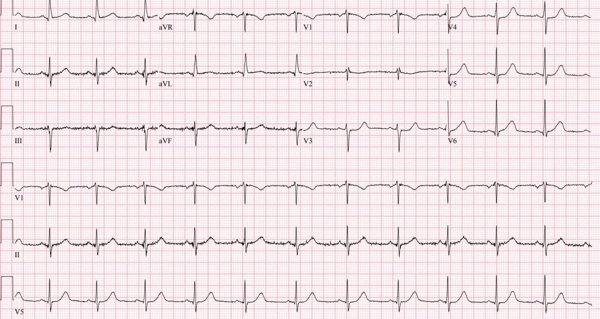 Jack Cahill (@theecgmedic) on Twitter photo Credit to <a href="/DidlakeDW/">David Didlake</a>
This takes an expert eye!
so so many would miss this!
#ECG #ECGChallenge Credit to <a href="/DidlakeDW/">David Didlake</a>
This takes an expert eye!
so so many would miss this!
#ECG #ECGChallenge