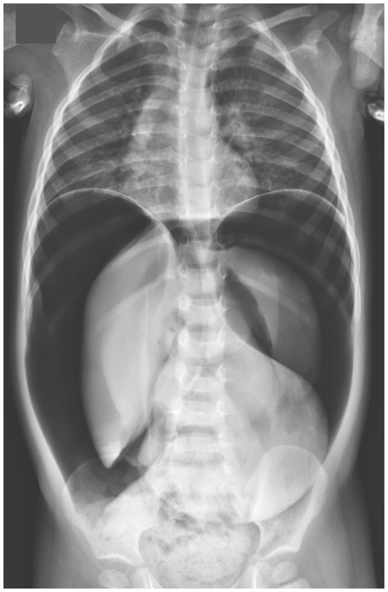 drkeithsiau's tweet photo. Angel wings appearance on an abdominal X-Ray. What do you see? https://t.co/H60wyf3ImR