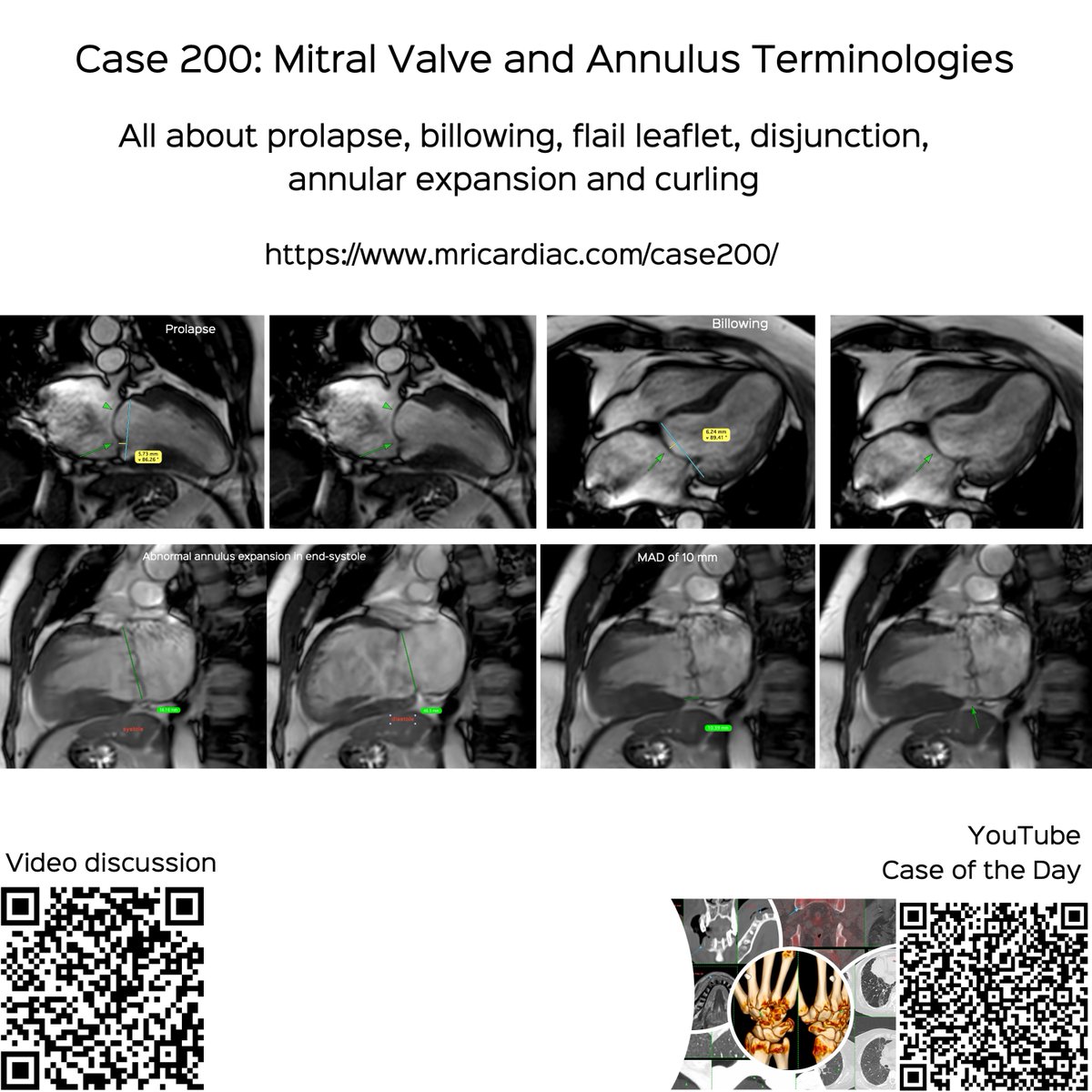bhavinj's tweet image. Case 200: Mitral Valve and Annular Terminologies: Prolapse, Billowing, Disjunction, Annual Expansion, Curling

All these terminologies deconstructed

Case link:
mricardiac.com/case200/

#cmrsimplified #cmr #cardiacmri #whyCMR #mitralvalve #mitralannulardisjunction