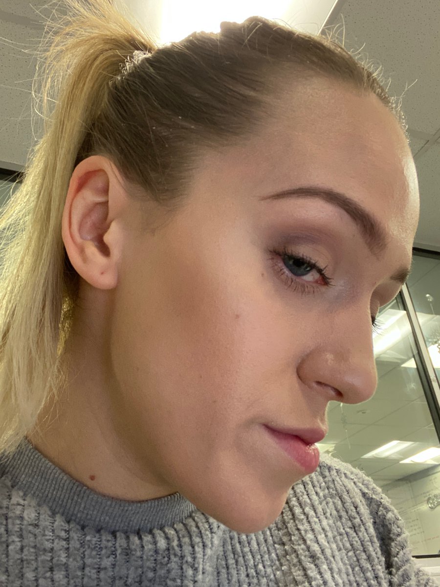 🗣️ Name: Melissa
❤️ Skin concern: Acne
⏰ Treatment length: 18 months

#tretinoin #acne #dermatology