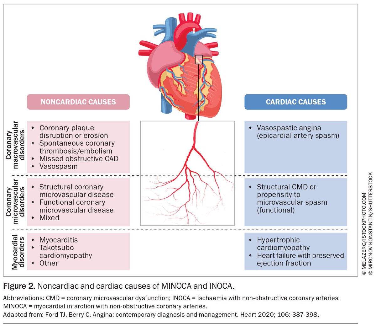 INOCA and MINOCA: coronary vasomotor disorders in clinical practice...

medicinetoday.com.au/mt/2024/septem…