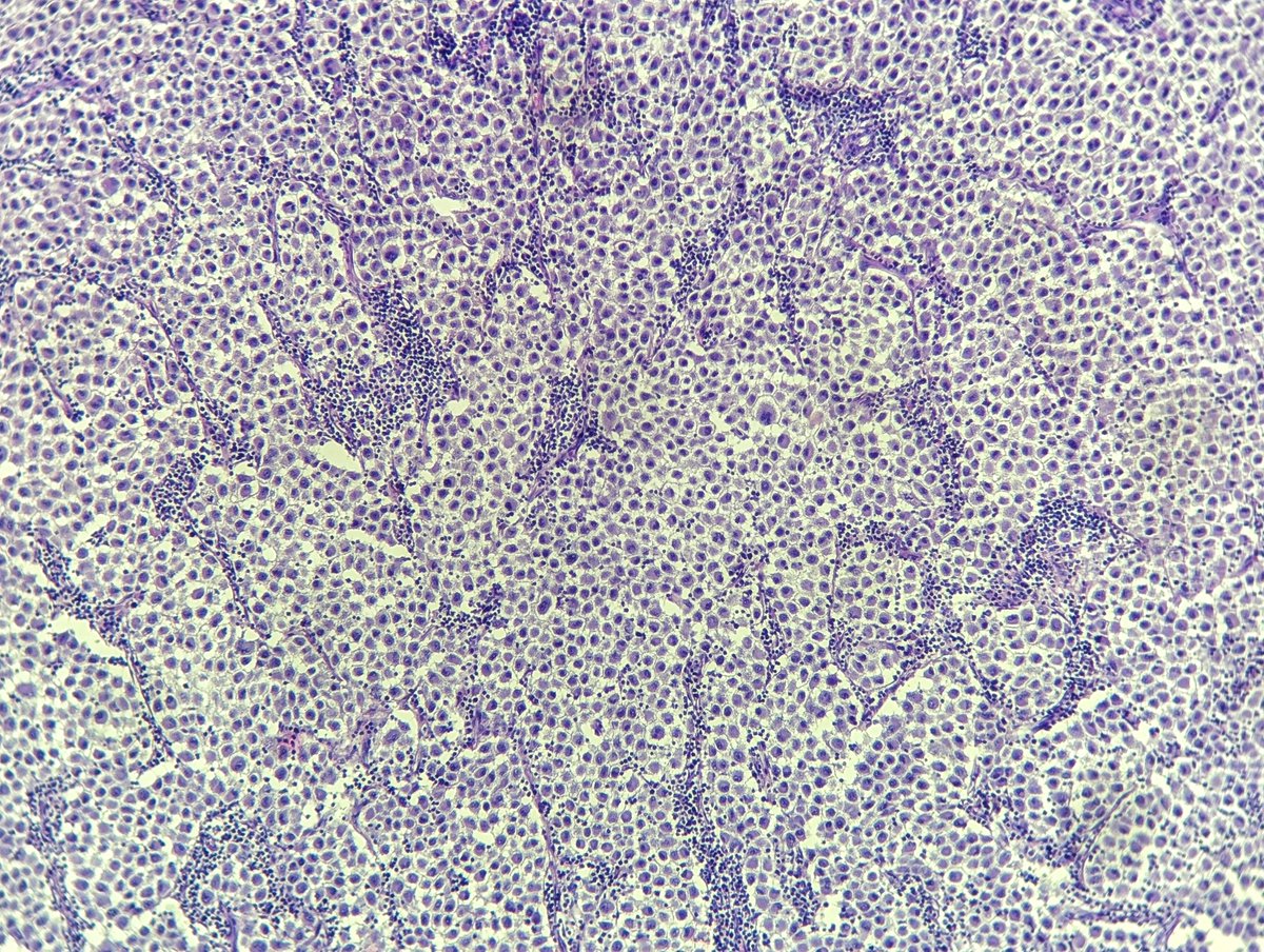 DocFaustus's tweet image. Different faces of metastatic melanoma.

#pathology #dermpath #PathTwitter