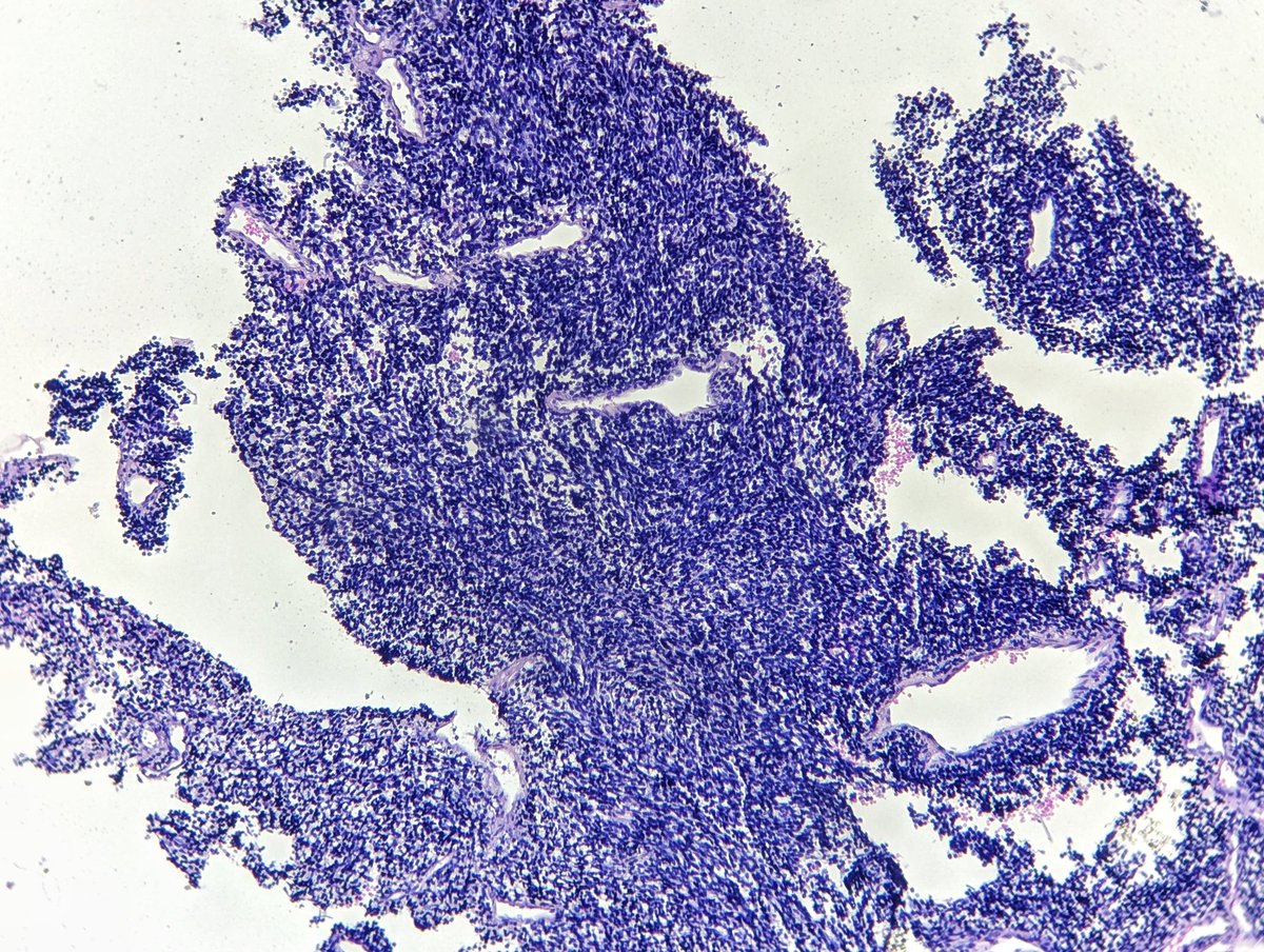 DocFaustus's tweet image. Different faces of metastatic melanoma.

#pathology #dermpath #PathTwitter
