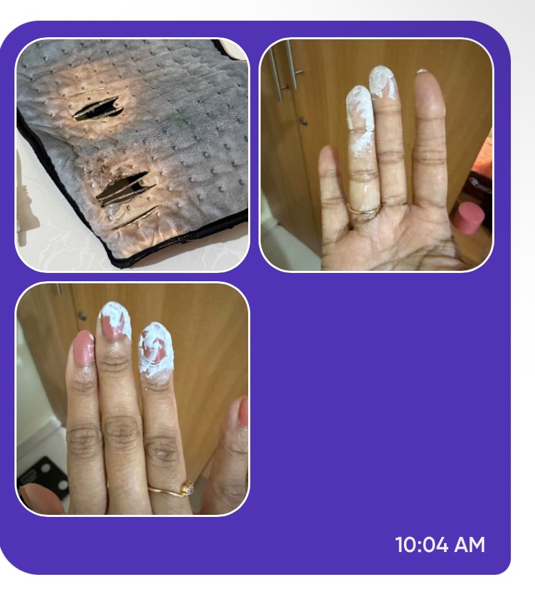 MoorthyNeerja's tweet photo. horrible service from @SwiggyInstamart . ordered a heating pad and within a day’s use it was burnt while on use, putting me at huge risk. When raised a support ticket and requested for a call,no acknowledgement received. Is this your customer service @SwiggyInstamart ?? https://t.co/yxoXEDyICW