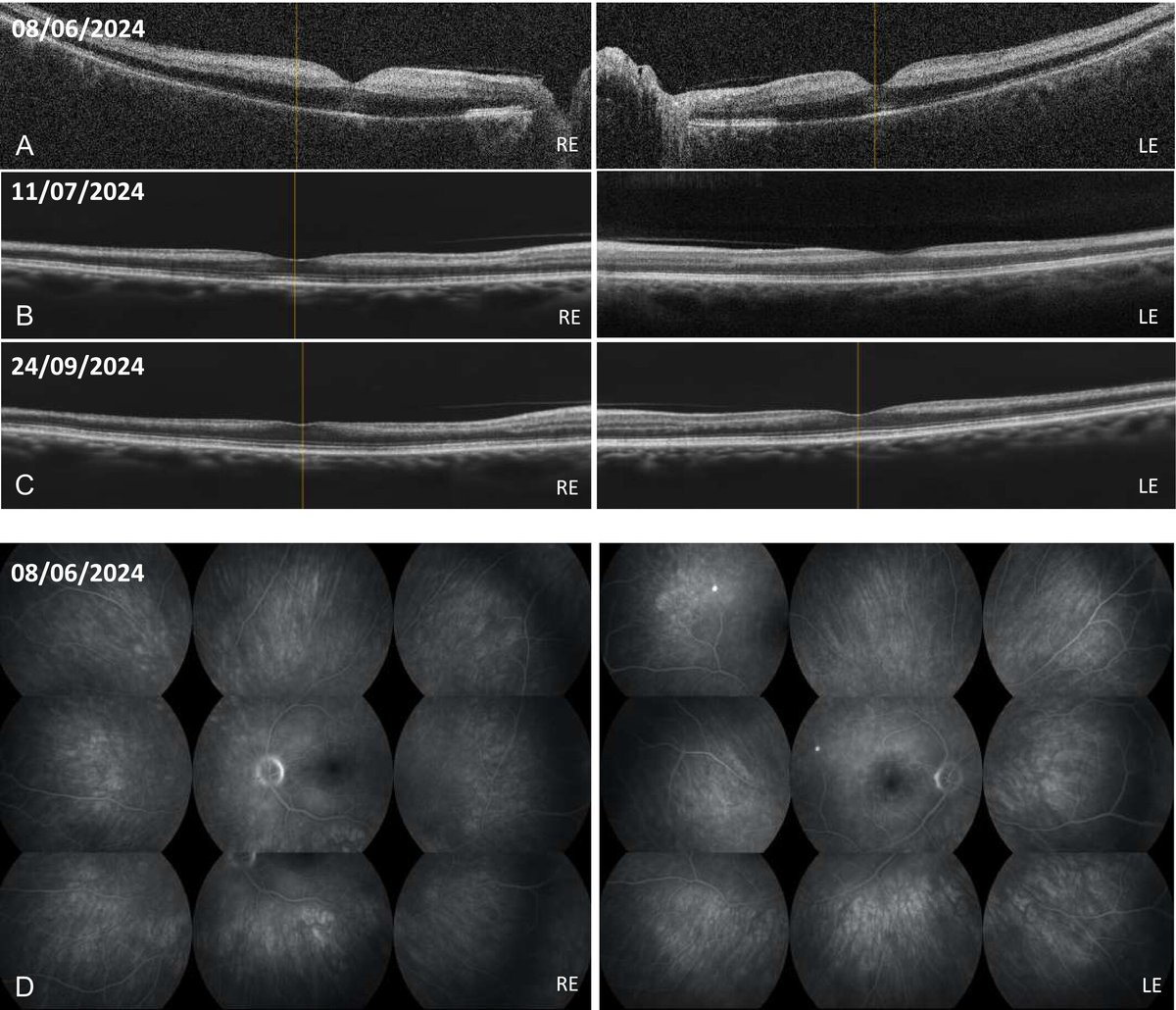 ACR_Journals (@acr_journals) on Twitter photo A 61-year-old man with history of chronic eosinophilic rhinosinusitis and eosinophilic asthma managed with benralizumab presented with sudden bilateral visual loss and transient amaurosis
Case report in ACR Open Rheumatology
doi.org/10.1002/acr2.7… A 61-year-old man with history of chronic eosinophilic rhinosinusitis and eosinophilic asthma managed with benralizumab presented with sudden bilateral visual loss and transient amaurosis
Case report in ACR Open Rheumatology
doi.org/10.1002/acr2.7…