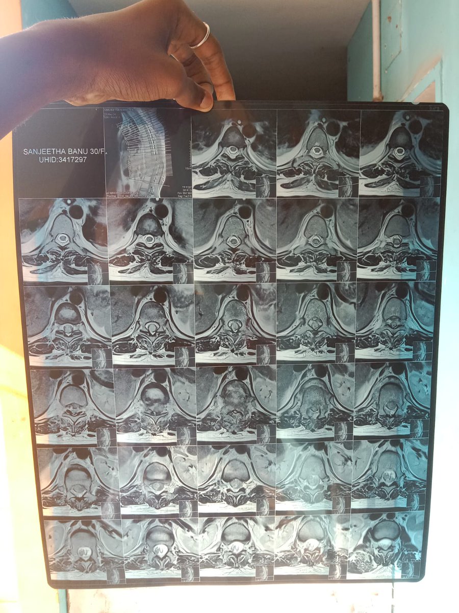 இது எனக்கு தெரிந்த அக்காவின் முதுகெலும்புவில் உள்ள நரம்பு கட் ஆகி ஆபரேஷன் செய்து ஒரு வருடம் ஆகியும் இன்றும் அவரால் எந்திரிச்சி நடக்க முடியவில்லை. பல முயற்சி செய்தும் அவரால் எதுவும் செய்ய முடிய வில்லை. இப்பொழுது அவர் வீட்டார்கள் கை விட்டு சென்றுவிட்டார்கள் 
<a href="/offl_Lawrence/">Raghava Lawrence</a>