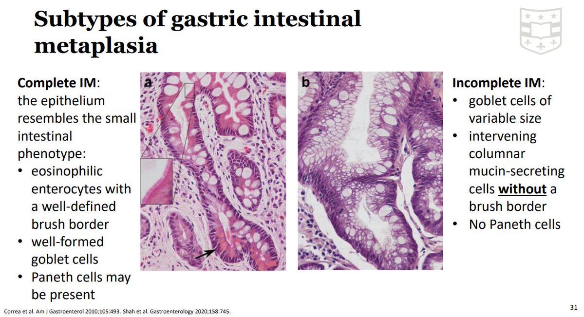 Janiranavarro's tweet photo. Gastric intestinal metaplasia
Complete IM: Well formed goblet cells, enterocytes with well defined brush borders and Paneth cells may be present
Incomplete IM: Goblet cells of variable size, columnar cells with no brush border and no Paneth cells

Extent of IM
Extensive: IM involving at least the corpus
Limited: IM involving only the antrum/incisura

Dr. Ma #USCAP25 #pathology #PathX