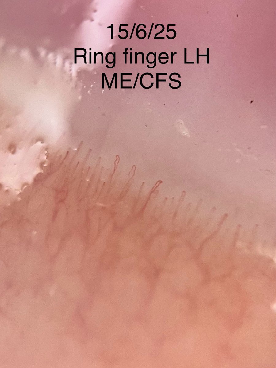 Naomi Harvey PhD #WearAMask (@naomi_d_harvey) on Twitter photo Just tried my clip on phone microscope 🔬 to check my nail food capillaries and it’s worked incredibly well. This is amazing.
<a href="/BanhamGemma/">Gemma Banham</a> <a href="/renesugar/">Rene Sugar</a> <a href="/IsabelRamirezRD/">Isabel Ramirez-Burnett | Renegade Research</a> <a href="/dbkell/">Prof Doug Kell CBE #FBPE #FBPA🔶🇪🇺</a> <a href="/PutrinoLab/">Putrino Lab</a> <a href="/healingfromlc/">Céline</a> Just tried my clip on phone microscope 🔬 to check my nail food capillaries and it’s worked incredibly well. This is amazing.
<a href="/BanhamGemma/">Gemma Banham</a> <a href="/renesugar/">Rene Sugar</a> <a href="/IsabelRamirezRD/">Isabel Ramirez-Burnett | Renegade Research</a> <a href="/dbkell/">Prof Doug Kell CBE #FBPE #FBPA🔶🇪🇺</a> <a href="/PutrinoLab/">Putrino Lab</a> <a href="/healingfromlc/">Céline</a>