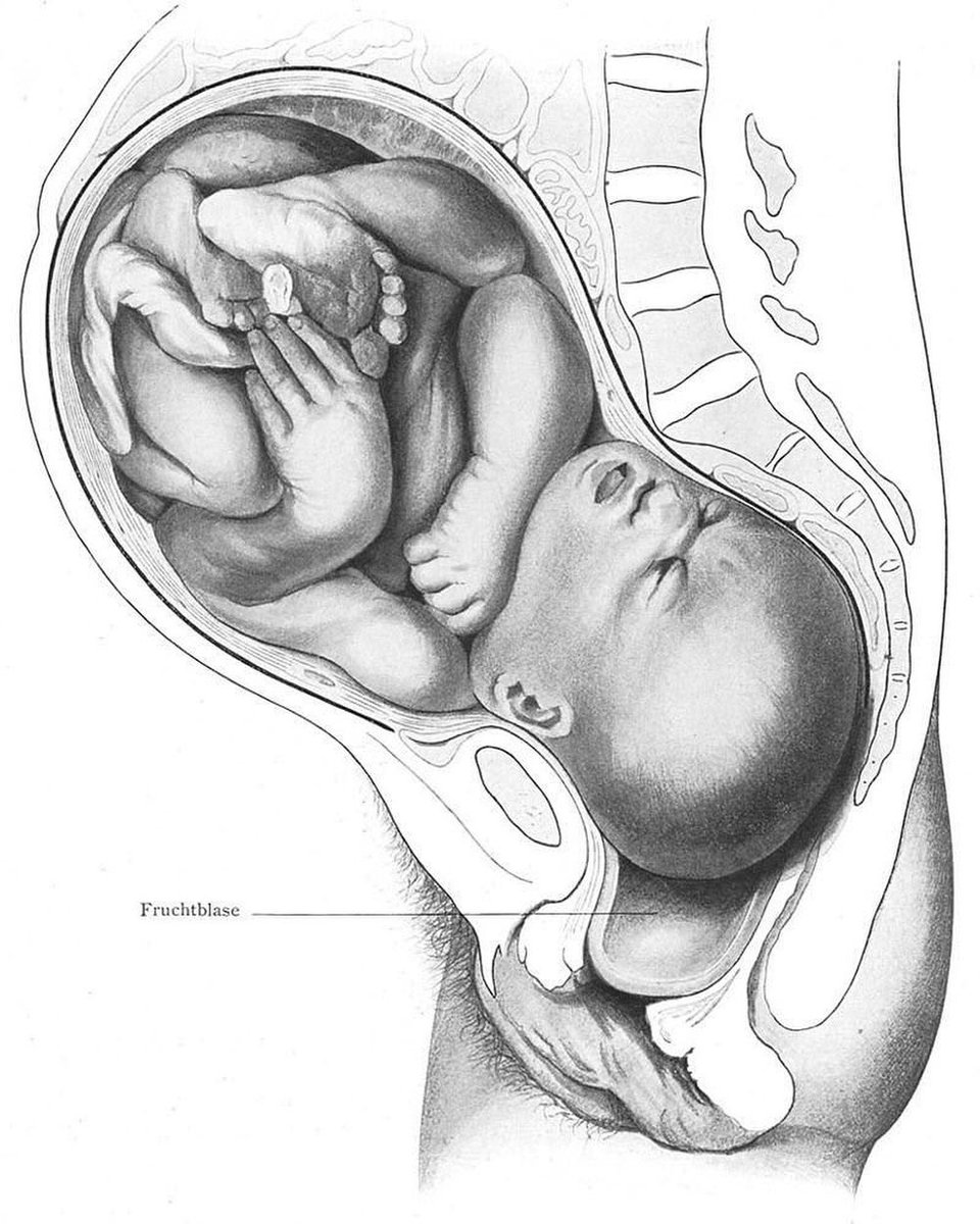 Illustration of the fetus passing through the lesser pelvis by Ernst Bumm and Albrecht Mayer 1902 #histmed #historyofmedicine #OBGYN #pastmedicalhistory