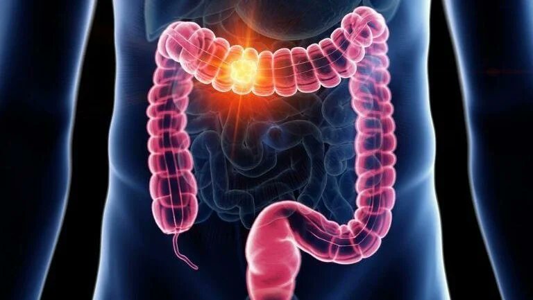 OncoDaily GI (@oncodailygi) on Twitter photo New Meta-Analysis on Neoadjuvant Chemotherapy in Colon Cancer from Mayo Clinic - Christopher Williams
<a href="/RichardSassun/">Richard Sassun M.D.</a> | <a href="/DrDavidLarson/">David Larson, MD MBA</a> | <a href="/EricDozoisMD/">Eric J. Dozois</a> | <a href="/3isac/">Isacco Montroni</a>
oncodaily.com/insight/neoadj…
#Cancer #ColonCancer #MayoClinic #MedEd #MedX #NeoadjuvantChemotherapy #OncoDaily #Oncology New Meta-Analysis on Neoadjuvant Chemotherapy in Colon Cancer from Mayo Clinic - Christopher Williams
<a href="/RichardSassun/">Richard Sassun M.D.</a> | <a href="/DrDavidLarson/">David Larson, MD MBA</a> | <a href="/EricDozoisMD/">Eric J. Dozois</a> | <a href="/3isac/">Isacco Montroni</a>
oncodaily.com/insight/neoadj…
#Cancer #ColonCancer #MayoClinic #MedEd #MedX #NeoadjuvantChemotherapy #OncoDaily #Oncology