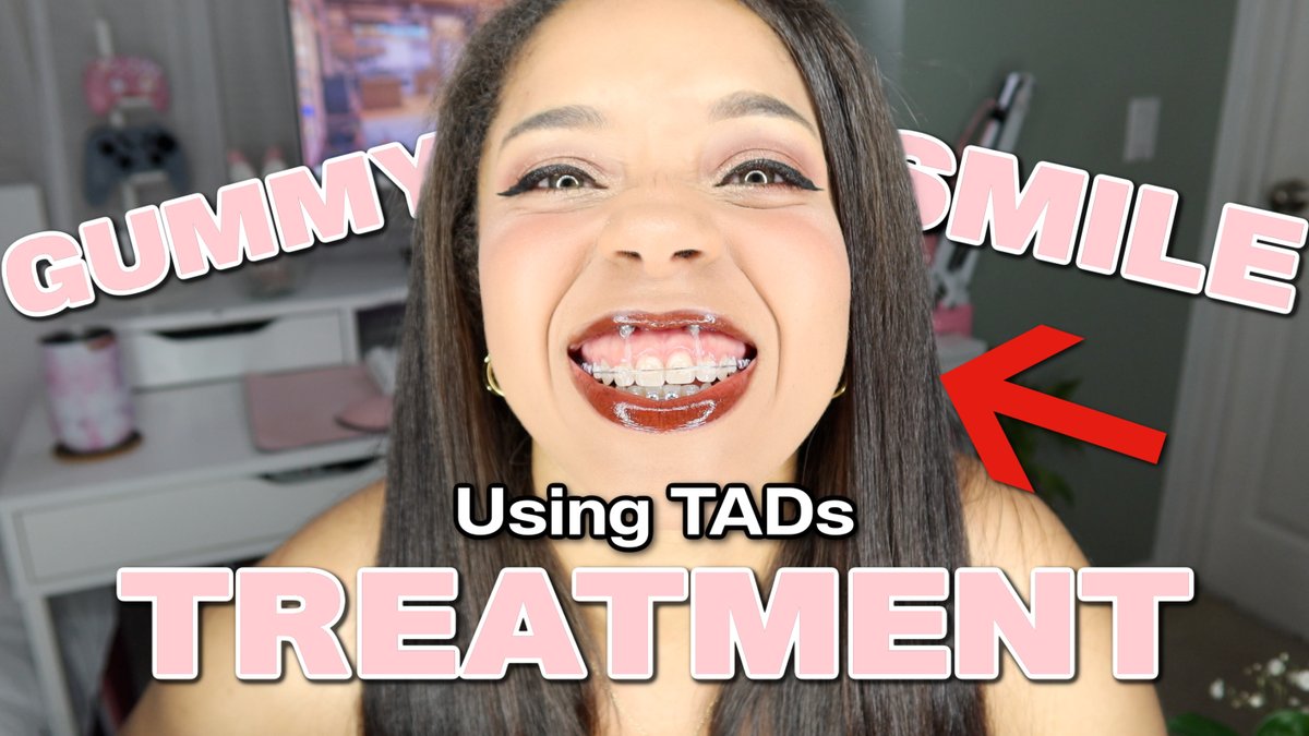 A new video is LIVE on my YouTube channel!🎥🥹 I got IMPLANTS! TADs for GUMMY SMILE ✧ Before &amp; After + My Experience Braces Vlog! 

youtube.com/watch?v=NyYODr…

#Braces #BracesJourney #BracesTADs