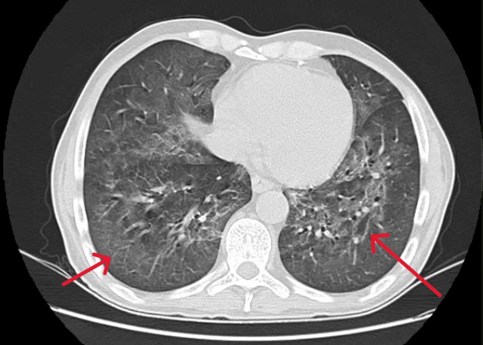 pulmonologist4's tweet photo. 【Case Rep】HIV陽性ニューモシスチス肺炎 (PCP)
Cureus 2025.

56歳男性。HIV既往。
呼吸困難で来院、画像所見とBALFのPCR＋でPCPと診断。
クリプトコッカスの菌血症と頭蓋内病変も合併したため併せて治療。
AIDSで複数の日和見感染の同時合併は珍しくないと報告。 
https://t.co/3Lh4kzhWWT https://t.co/QuwqQJZ9p5