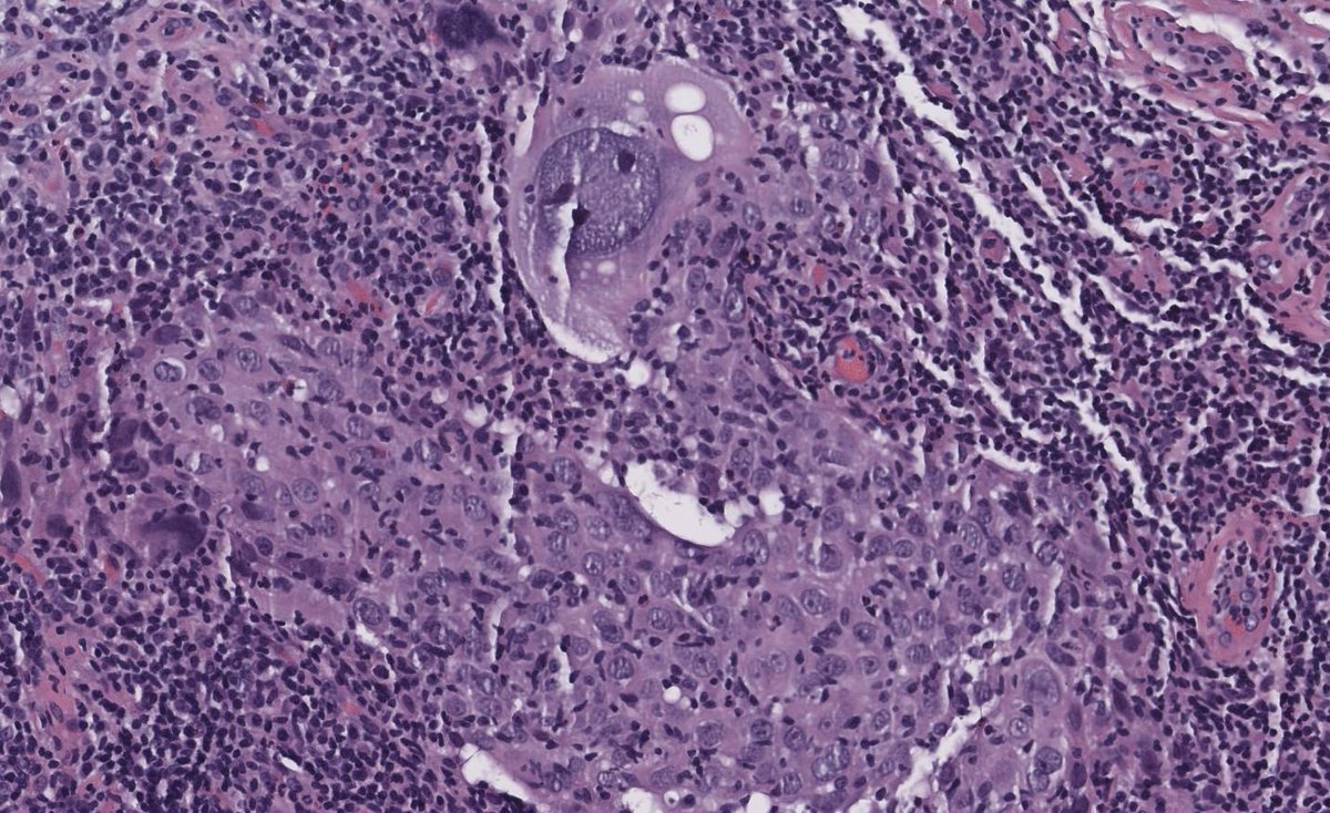OOPathMD's tweet photo. Has to be the largest invasive ductal carcinoma cell (singly nucleated) I’ve ever seen… https://t.co/qRllPZJfor