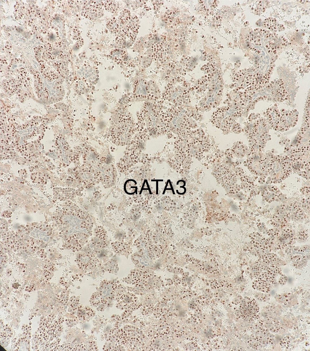 👄 All right, yesterday, I talked about acinic cell carcinoma.

🤔Well...how about this one

👄 45 y/o M with parotid mass

Photo Credit: Jessica Lawson, MD

#pathx #cytopath #ent #hemeonc #pathtwitter