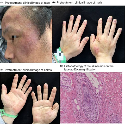 A rare case of eosinophilic pustular folliculitis with palmoplantar and facial involvement, successfully treated with apremilast with no adverse effects or recurrence. Could PDE4 inhibition be a viable option in refractory EPF? Read more: doi.org/10.1093/skinhd…