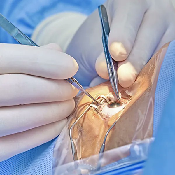 gemsofbabus_'s tweet image. Cataract Surgery!

🇮🇳 India: 8.5 million/yr
🇨🇳 China: 3.2 million/yr
🇺🇸 USA: 3.5 million/yr
🇪🇺 EU: ~4.7 million/yr

India performed more cataract surgeries than China and the US combined.

Today, blindness from cataracts is nearly wiped out in India.👀🙏