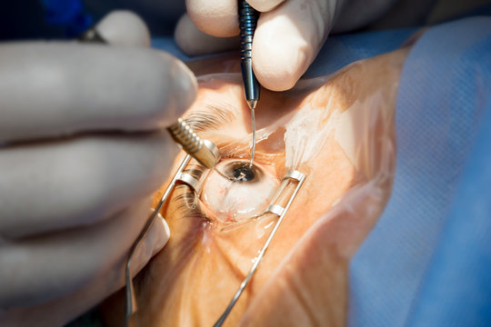 gemsofbabus_'s tweet image. Cataract Surgery!

🇮🇳 India: 8.5 million/yr
🇨🇳 China: 3.2 million/yr
🇺🇸 USA: 3.5 million/yr
🇪🇺 EU: ~4.7 million/yr

India performed more cataract surgeries than China and the US combined.

Today, blindness from cataracts is nearly wiped out in India.👀🙏