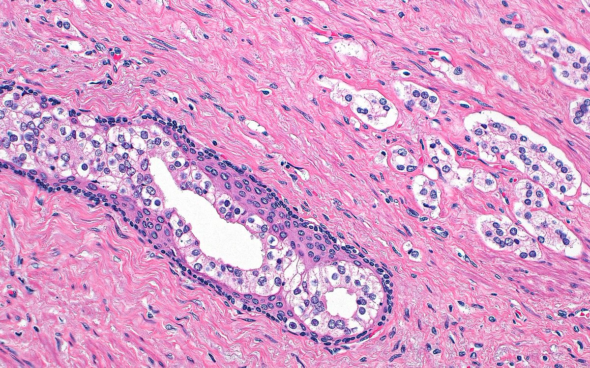 ziad_zaatari's tweet image. 🔬 Intraductal Prostatic Carcinoma ~ Prostate cancer cells colonizing a benign prostatic duct (left) adjacent to high grade invasive prostatic adenocarcinoma glands (right) ~ #GUpath #Pathology #Prostate