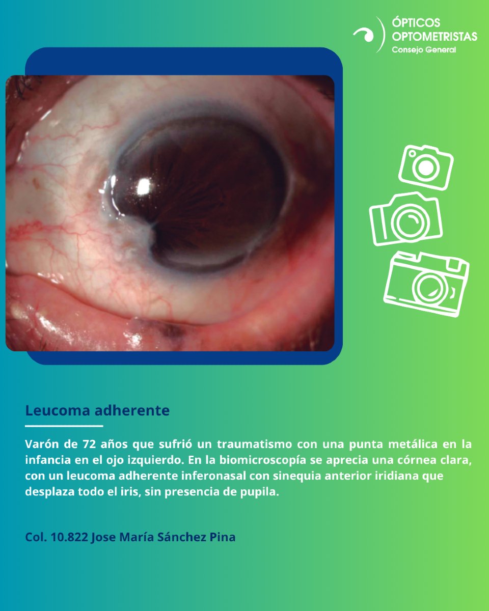 Cgcoo_es's tweet photo. 🏆📸#ConcursoFotografiaCientificaOcular | Foto seleccionada para optar al premio Carlos López H. de fotografía ocular Topcon España #LaGacetaCGCOO #Gaceta613 #leucoma #iris#cornea https://t.co/Is7ex1icu3