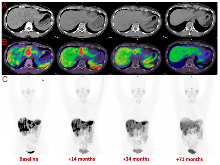 Peptide receptor radionuclide therapy in malignant insulinoma... Wonderful work from <a href="/DrDavePattison/">Dave Pattison</a> 

"PRRT provides durable hypoglycaemic and oncologic disease control of MI with manageable toxicity including hypoglycaemia flare requiring multidisciplinary care." 

Online