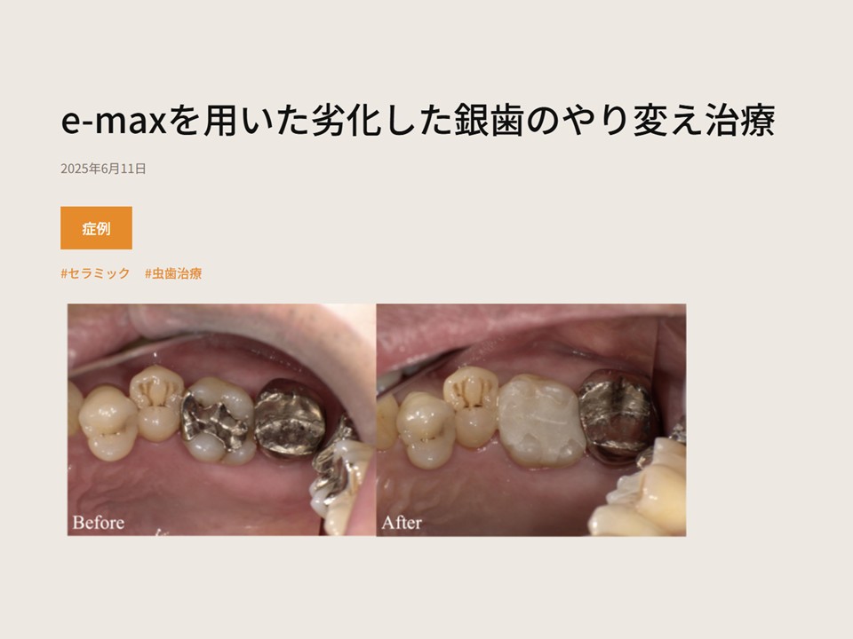 setagaya_DC's tweet photo. 症例をUPしました！！
【e-maxを用いた劣化した銀歯のやり変え治療】
https://t.co/3OXHySYOFr

＃せたがや歯科室　＃銀歯やりかえ治療　＃症例UP https://t.co/4XTeTPB2K2