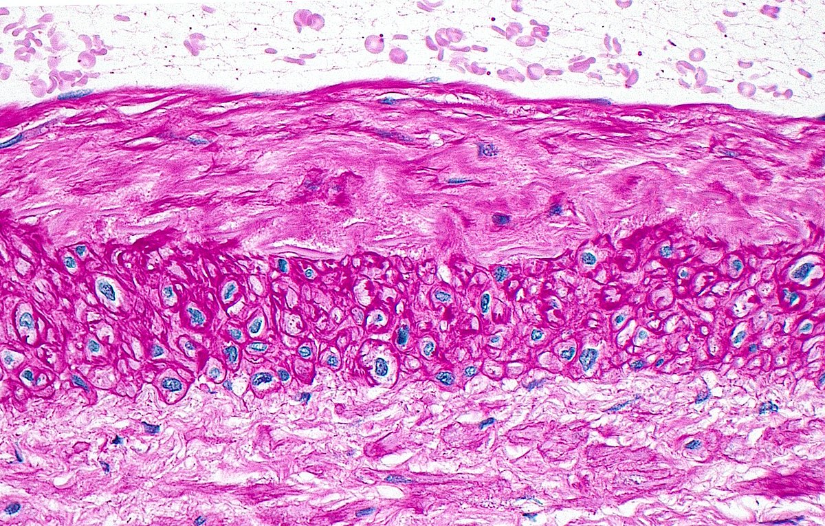 ziad_zaatari's tweet image. 🔬 Layers of a Renal Artery (PAS Stain) ~ #Histology #Pathology #renalpath
(From top to bottom):
▪️Lumen (containing RBCs)
▪️Intima (abnormally thickened here)
▪️Media (smooth muscle cells)
▪️Adventitia (outer connective tissue)