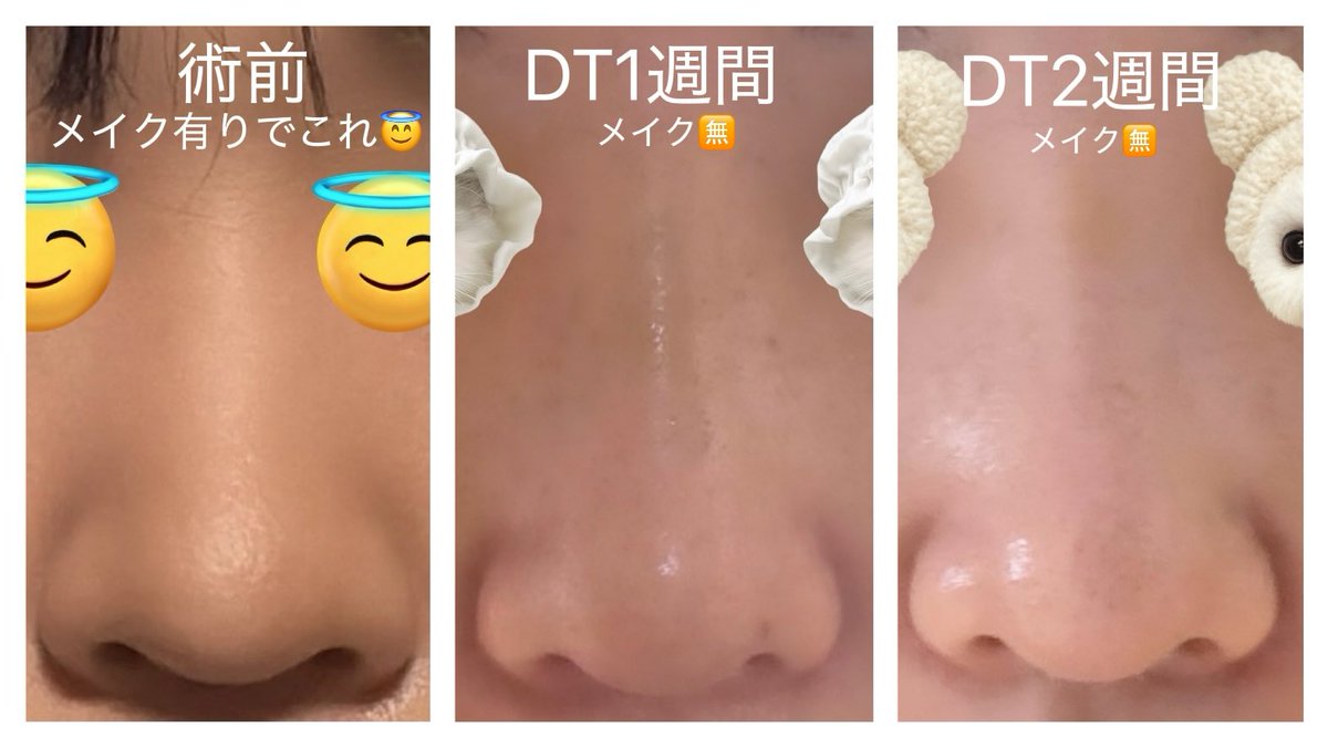 kjsnfm8's tweet photo. DT経過比較〜👃
1週間目に比べたらすこ〜し鼻先の腫れ引いたかも？
もっと引いてくれるのかな？💦
＃鼻整形 ＃ダウンタイム https://t.co/mXhQZjMtmx