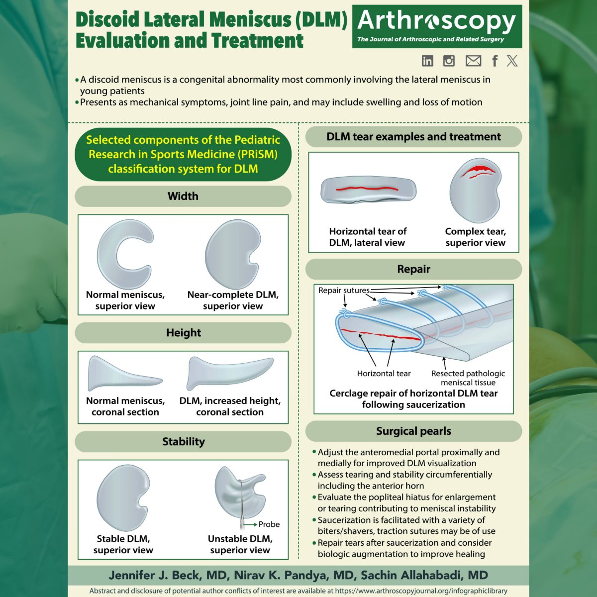 Arthroscopy Journal (@arthroscopyj) on Twitter photo Freshen up on discoid lateral meniscus with this helpful infographic from the current issue of Arthroscopy: ow.ly/SZkl50W9syl
From <a href="/JenniferJBeckMD/">Jennifer J. Beck, M.D.</a>, <a href="/DrNiravPandya/">Dr. Nirav Pandya, M.D.</a>, and @sach_MD
#DiscoidMeniscus #SportsMedicine #Orthopedics #Arthroscopy #KneeInjury #MeniscusTear Freshen up on discoid lateral meniscus with this helpful infographic from the current issue of Arthroscopy: ow.ly/SZkl50W9syl
From <a href="/JenniferJBeckMD/">Jennifer J. Beck, M.D.</a>, <a href="/DrNiravPandya/">Dr. Nirav Pandya, M.D.</a>, and @sach_MD
#DiscoidMeniscus #SportsMedicine #Orthopedics #Arthroscopy #KneeInjury #MeniscusTear