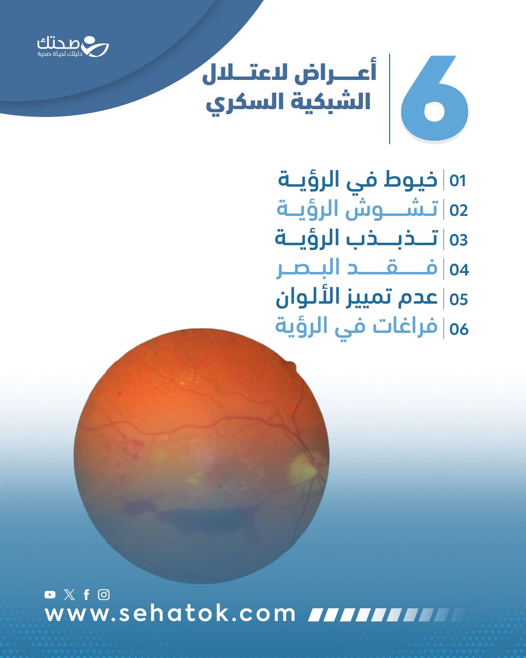 اعتلال الشبكية السكري من المضاعفات الصامتة والخطيرة لداء السكري، وقد يؤثر بشكل كبير على حاسة البصر دون إنذار واضح في البداية! تعرّف على 6 أعراض قد تكون أولى إشارات الخطر! #صحتك 
