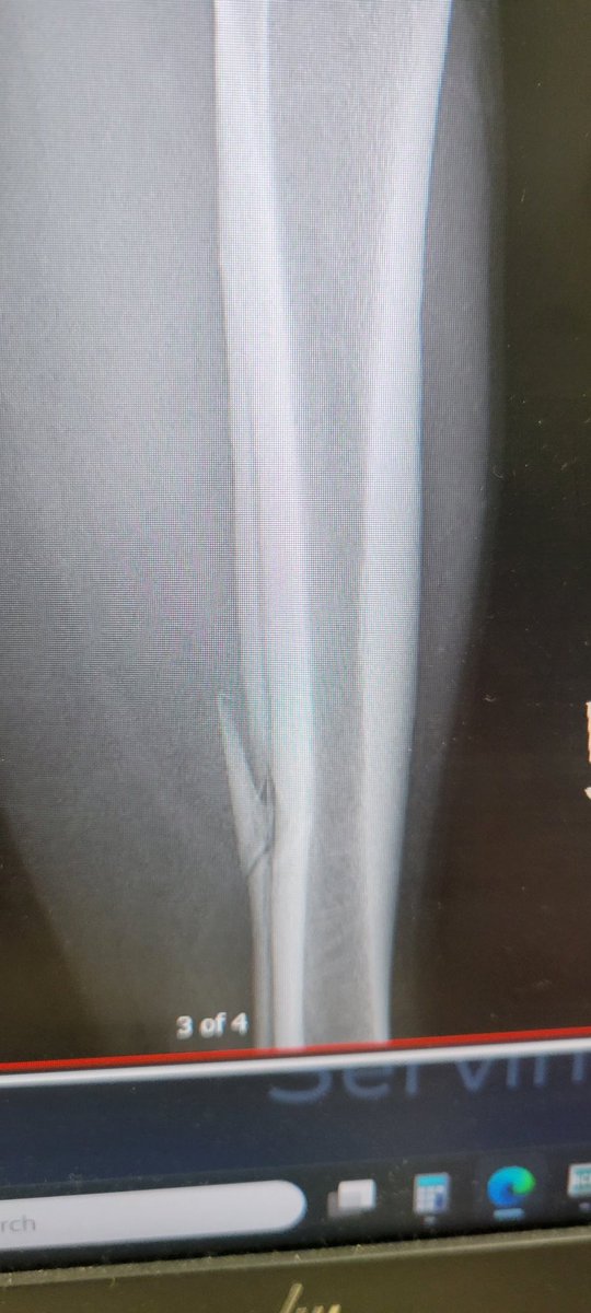 TexanKujo's tweet photo. Yay me. Broke the leg on Monday while play Volleyball. https://t.co/OO0r7FZ2Xr